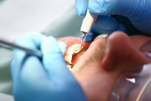 Best Dentist for Tooth Abscess  in Baltic, CT